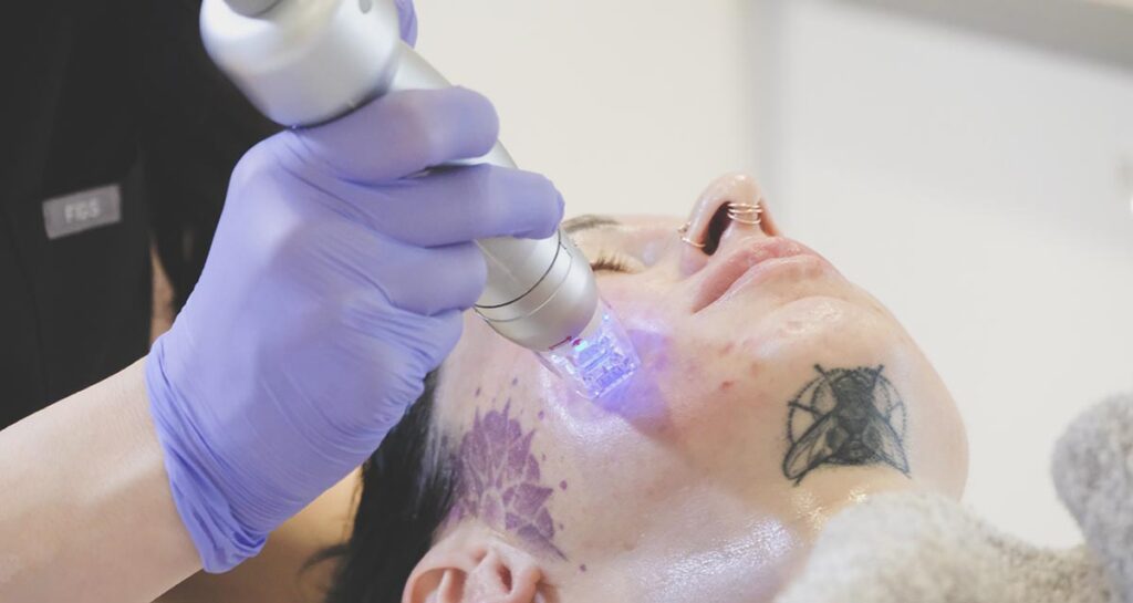 A skincare professional uses a blue LED light therapy device on a woman's face to treat acne scars, in a clinical setting at Seamless Skin MD in Santa Fe.