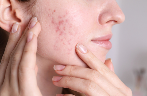 Woman with acne seeking treatment at Seamless Skin M.D. in Santa Fe.