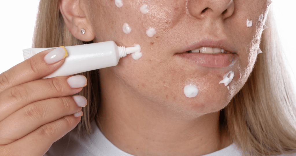 Applying cream on facial skin, one of the Best Adult Acne Treatments
