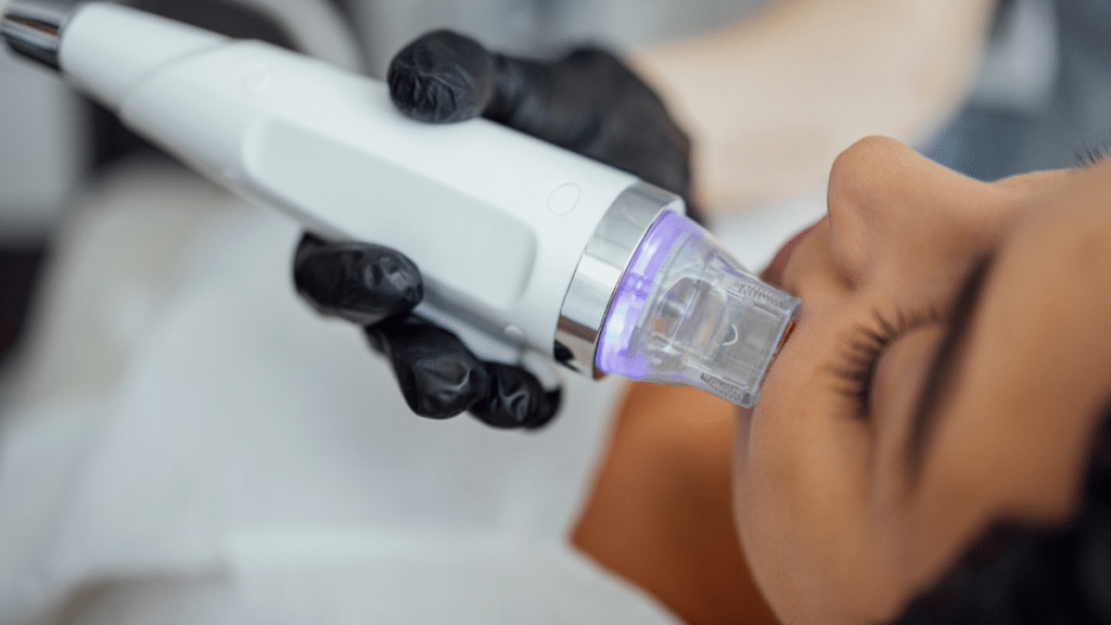 scarlet srf treatment with a device