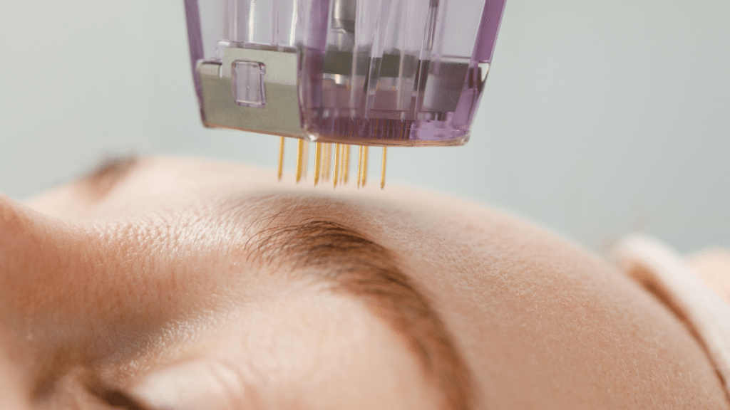scarlet srf treatment procedure on a forehead